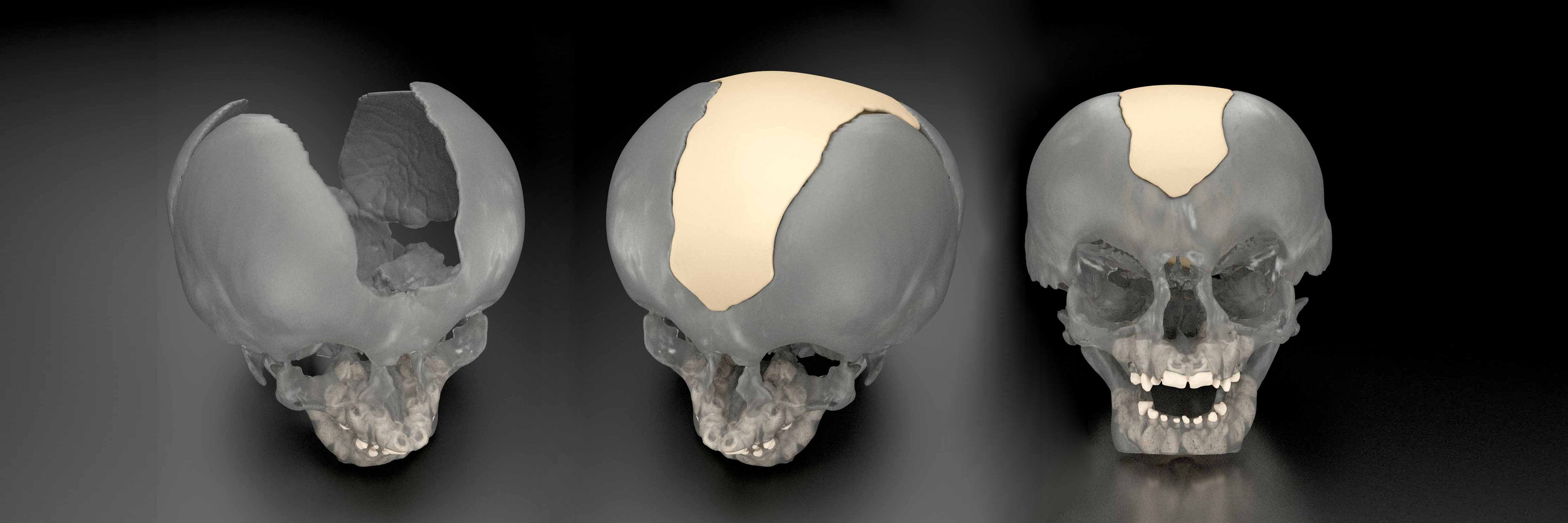 MedCAD - Custom Surgical Solutions