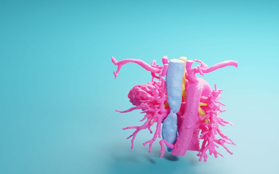 AccuModel aides in Planning for Pediatric Pulmonary Atresia